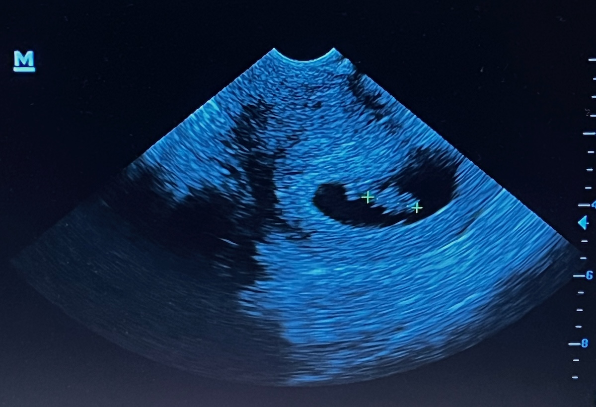 ultrasound image